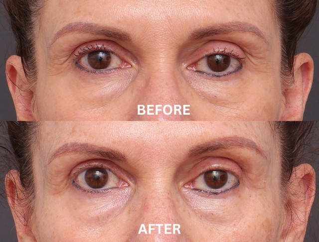 BLEPHAROPLASTY TEMPLATE 1