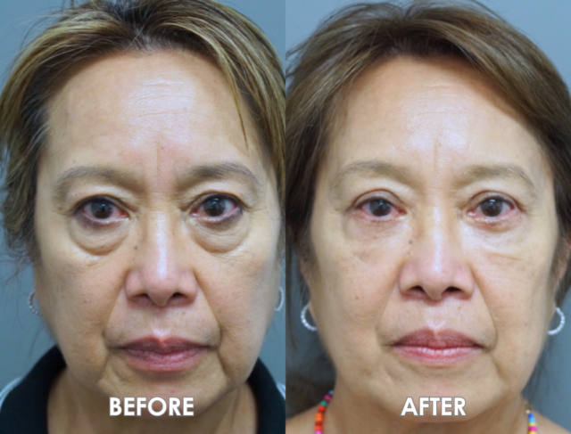 BLEPHAROPLASTY TEMPLATE 2