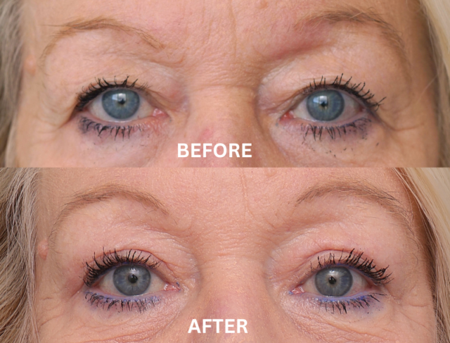 BLEPHAROPLASTY TEMPLATE
