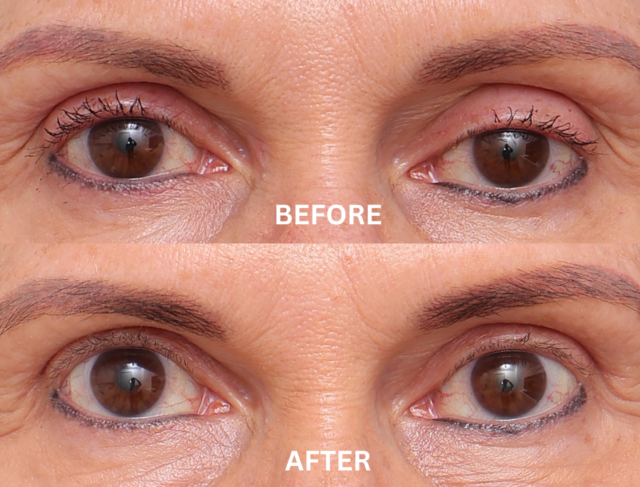 Blepharoplasty patient 2