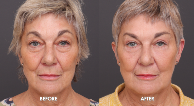 Copy of FACE NECK LIFT TEMPLATE 3