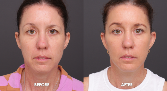Copy of FACE NECK LIFT TEMPLATE