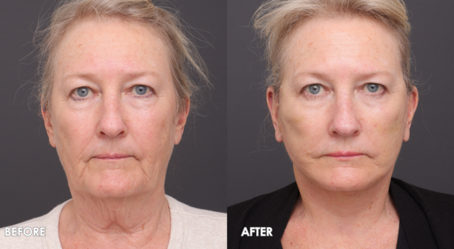 Copy of FACE NECK LIFT TEMPLATE