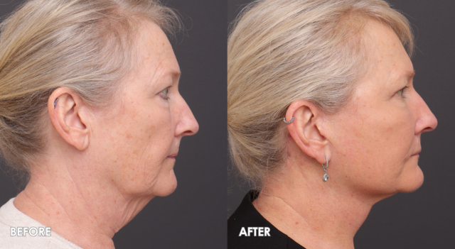 Face lift patient 1