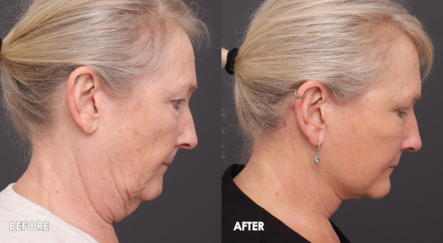 Face lift patient 2