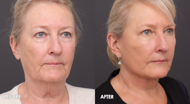 Face lift patient 3