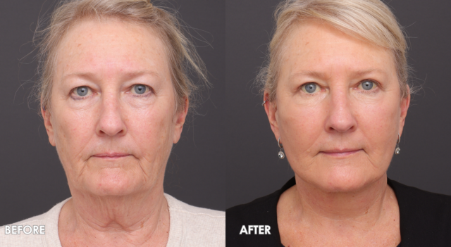 Face lift patient 4