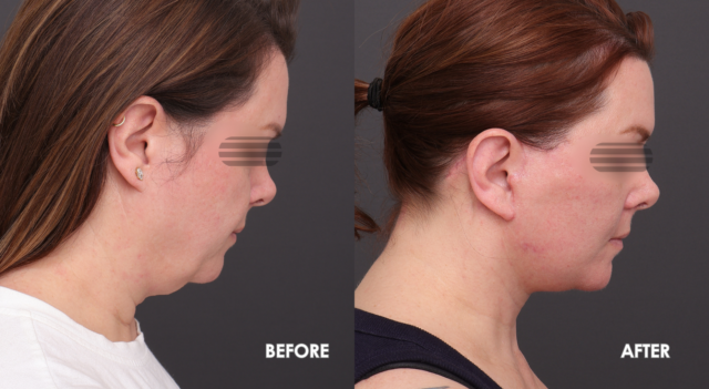 Face lift patient a 2