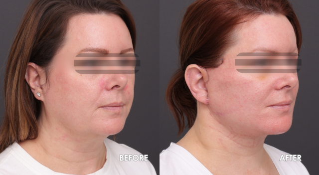 Face lift patient a 3