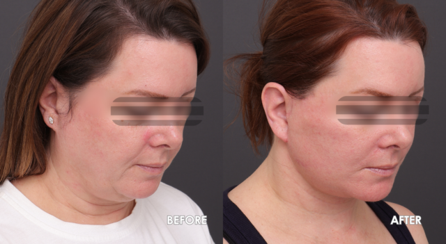 Face lift patient a 4