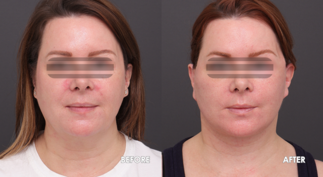 Face lift patient a 5