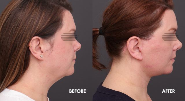 Face lift patient a