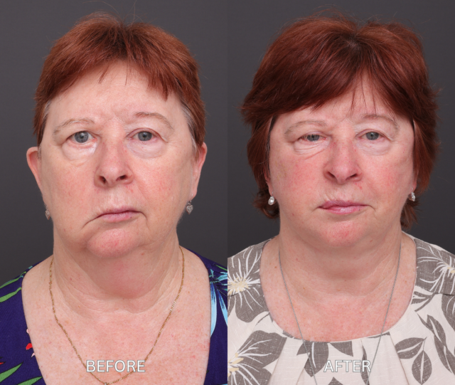 S BARAKAT FULL FACE PHOTOS