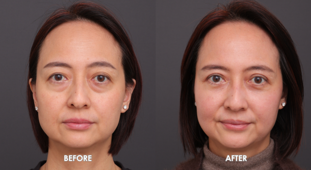 Blepharoplasty patient 1