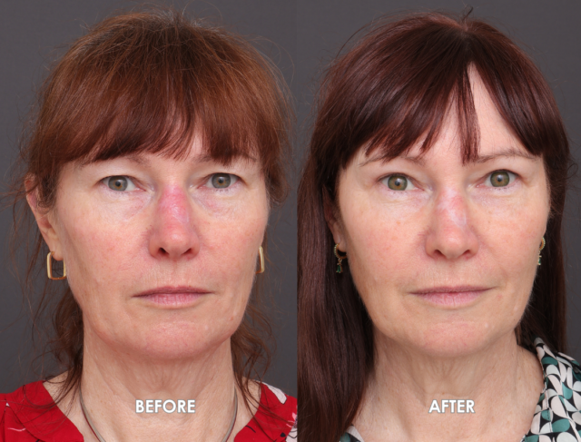 Blepharoplasty patient 2