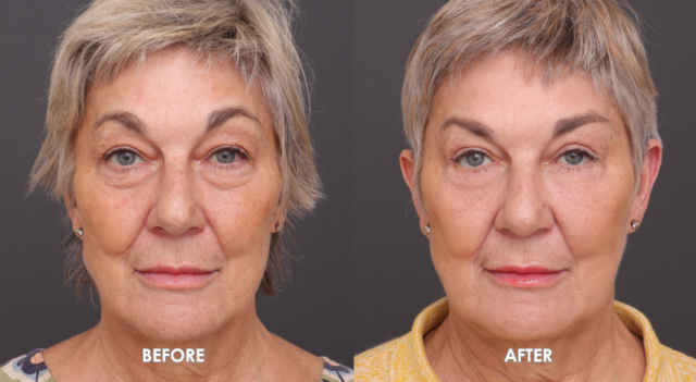 Blepharoplasty patient 8