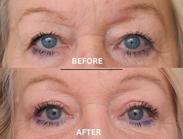 Blepharoplasty patient sydney 2