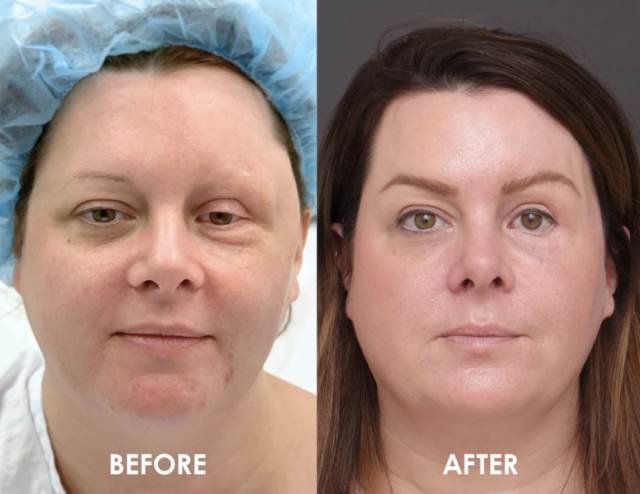 Blepharoplasty ptosis patient