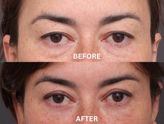 Blepharoplasty sydney patient