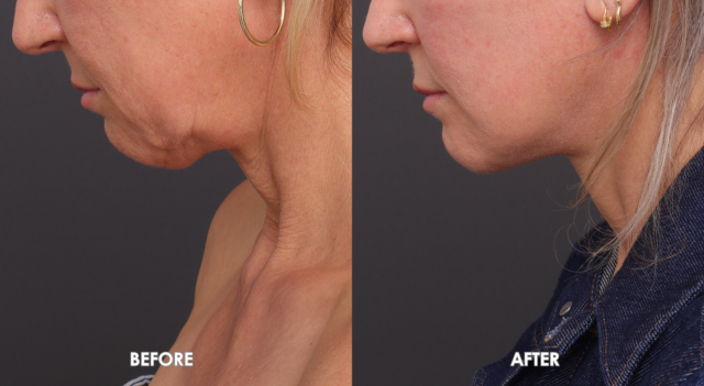 Face neck lift patient 2