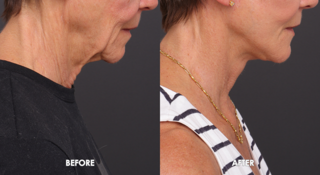 Face neck lift patient 2