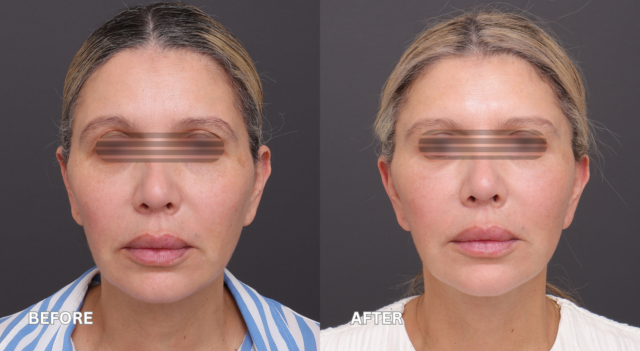 Face neck lift patient 3