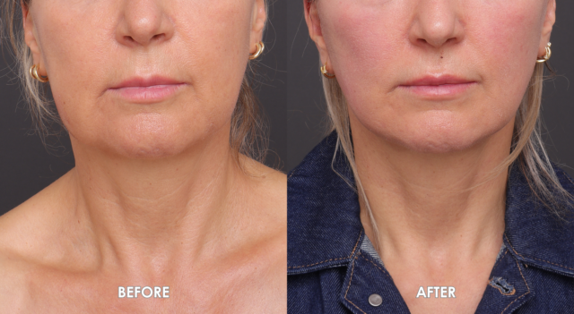 Face neck lift patient 3