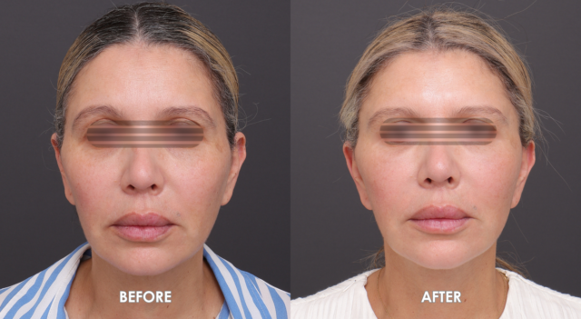 Face neck lift patient 3