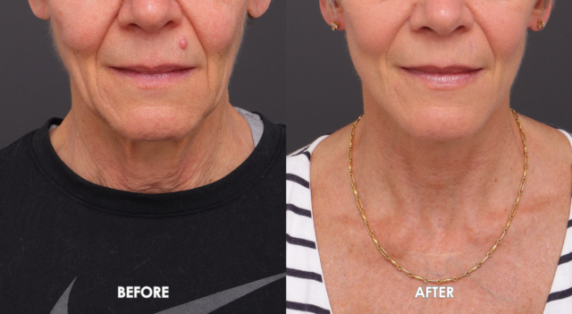 Face neck lift patient 3