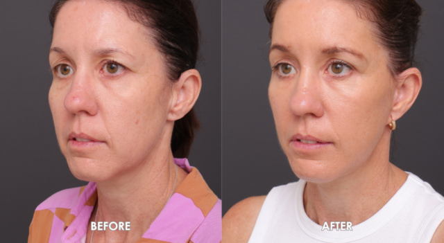 Face neck lift patient 45