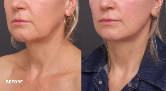 Face neck lift patient 45