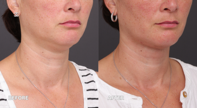Face neck lift patient 45
