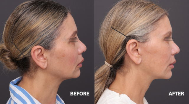 Face neck lift patient 4