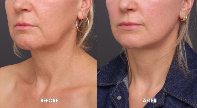 Face neck lift patient 4