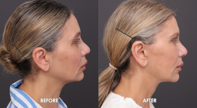 Face neck lift patient 4