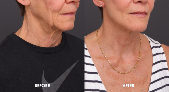 Face neck lift patient 4