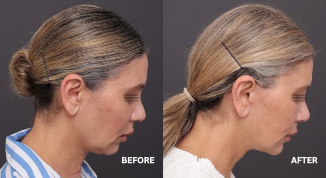 Face neck lift patient 6
