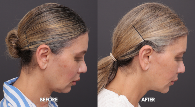 Face neck lift patient 6