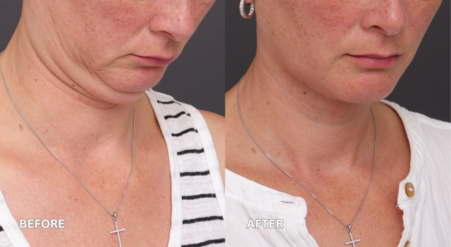 Face neck lift patient cornell