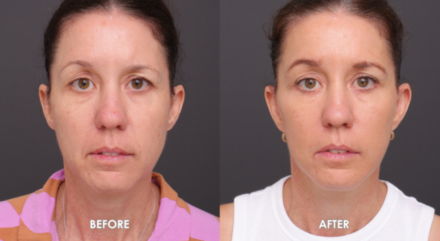 Face neck lift patient front