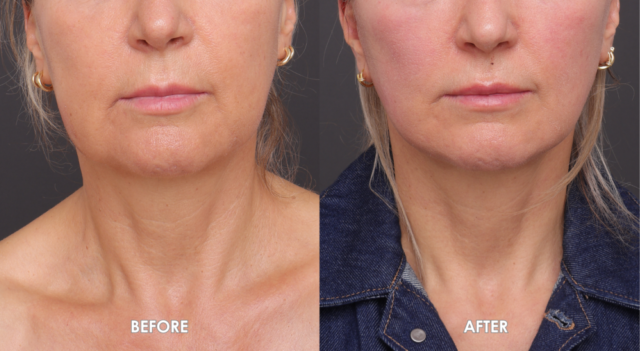 Face neck lift patient front