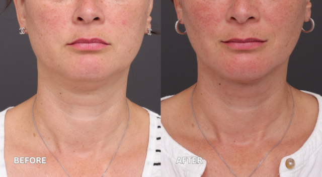 Face neck lift patient front