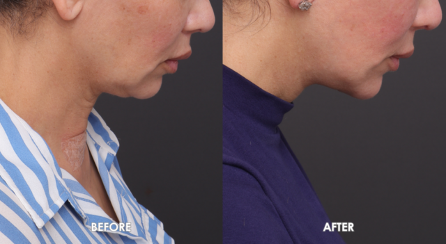 Face neck lift patient side cornell