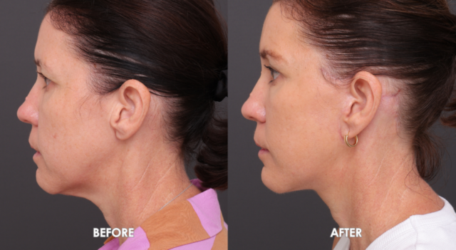 Face neck lift patient side