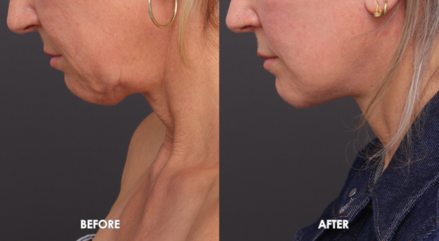 Face neck lift patient side