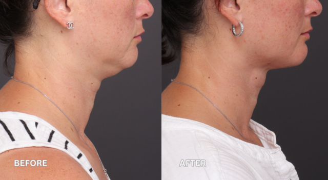 Face neck lift patient side
