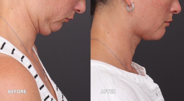 Face neck lift patient side cornell