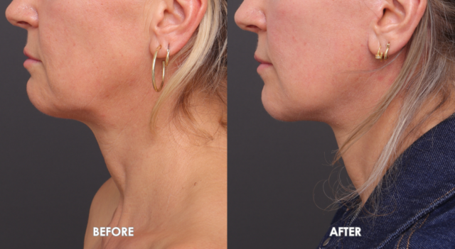 Face neck lift patient