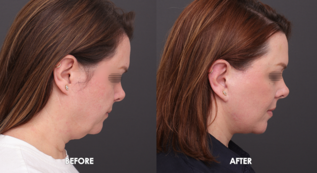 Face neck lift patient6 2