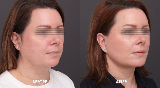 Face neck lift patient6 3
